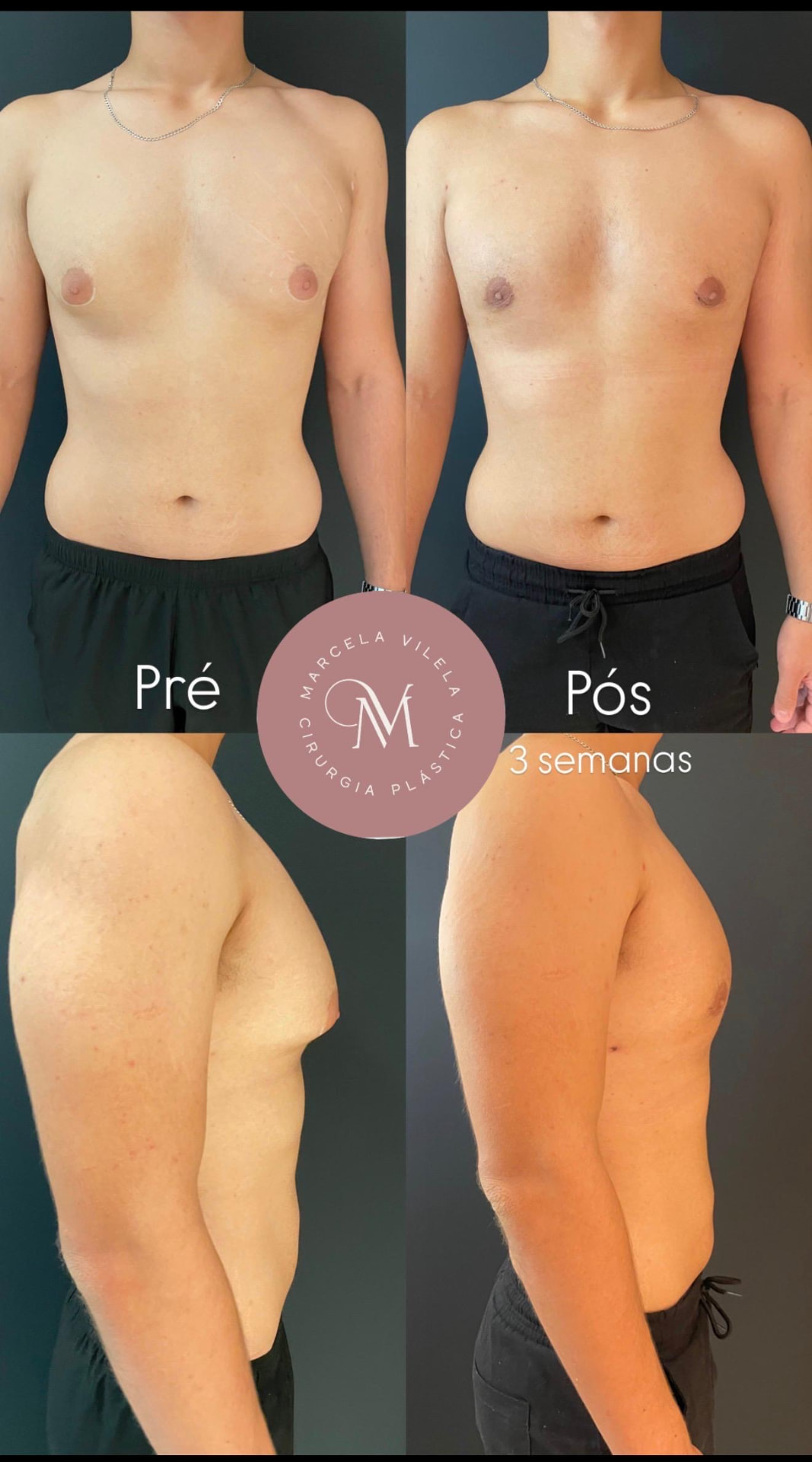 Antes e depois — Ginecomastia: Resultado com 3 semanas de pós