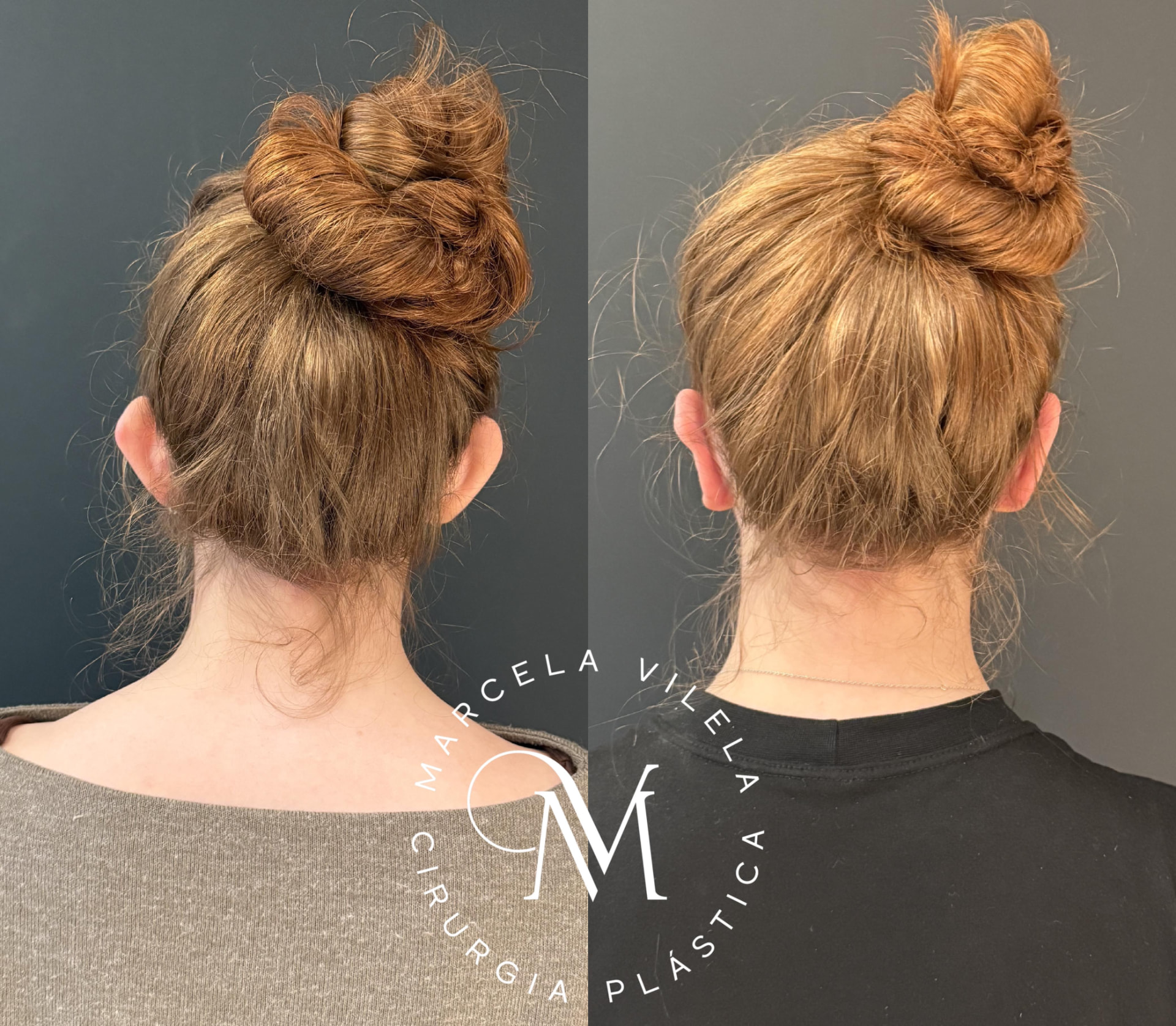 Antes e depois — Otoplastia: Correção do posicionamento das orelhas