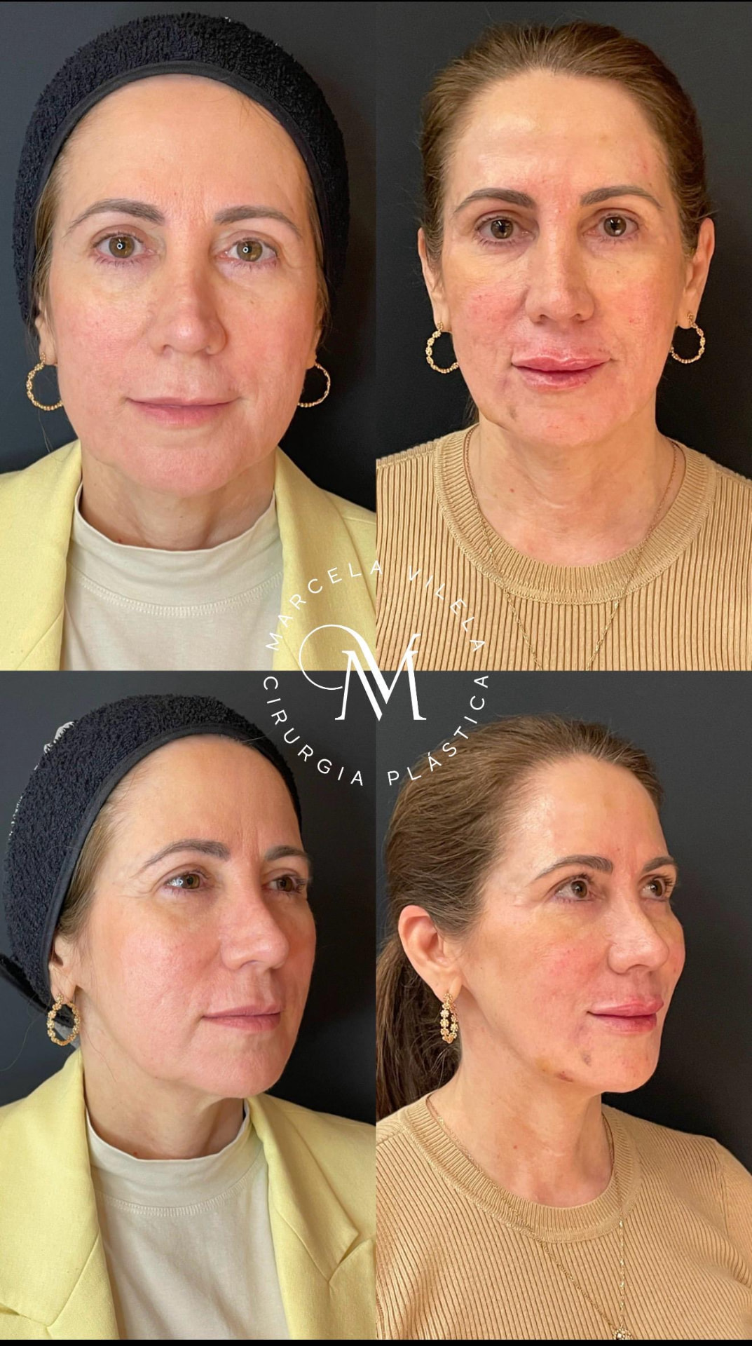 Antes e depois — Face: Rejuvenescimento facial natural