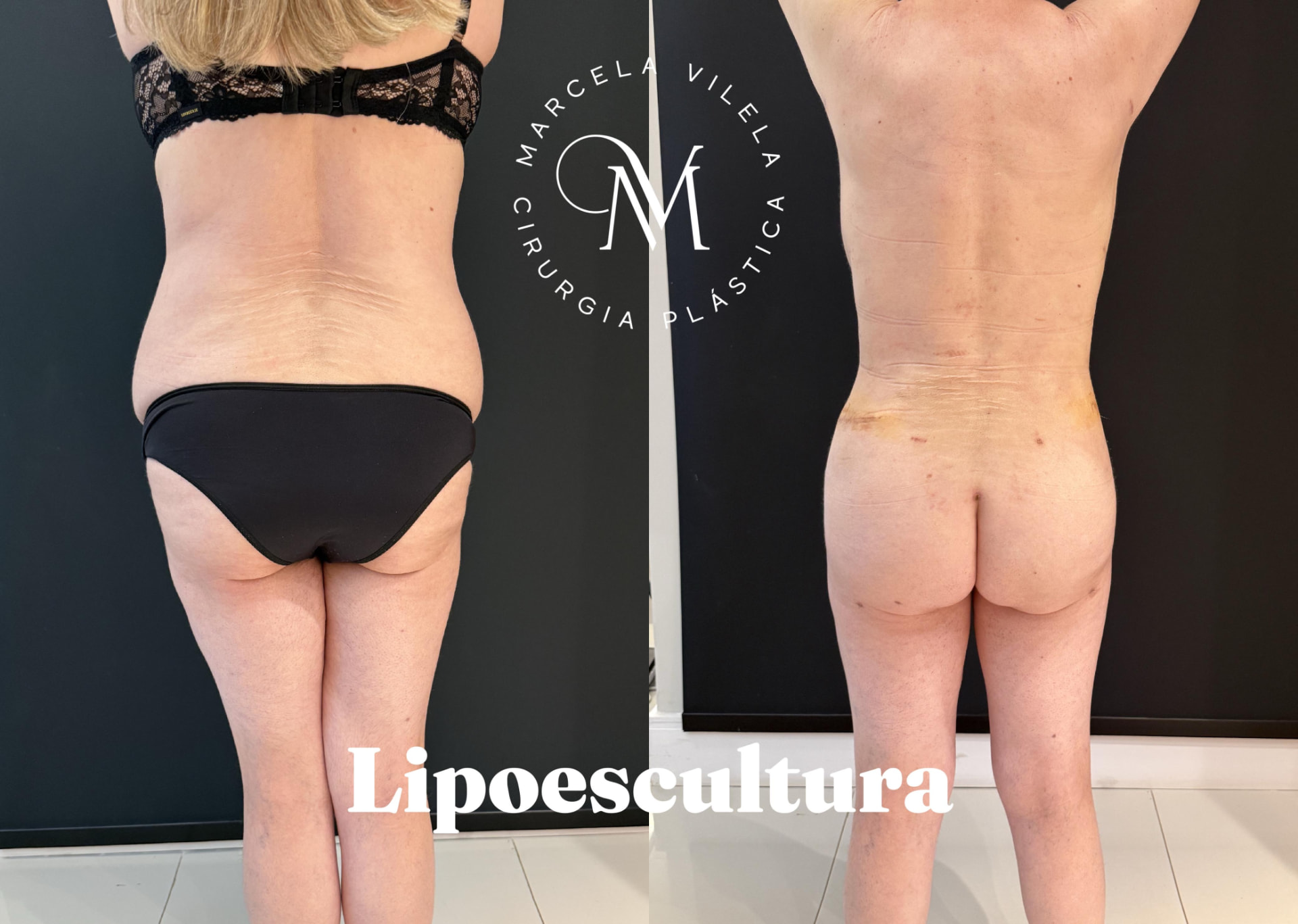 Antes e depois — Lipoescultura: Redefinição de cintura e dorso