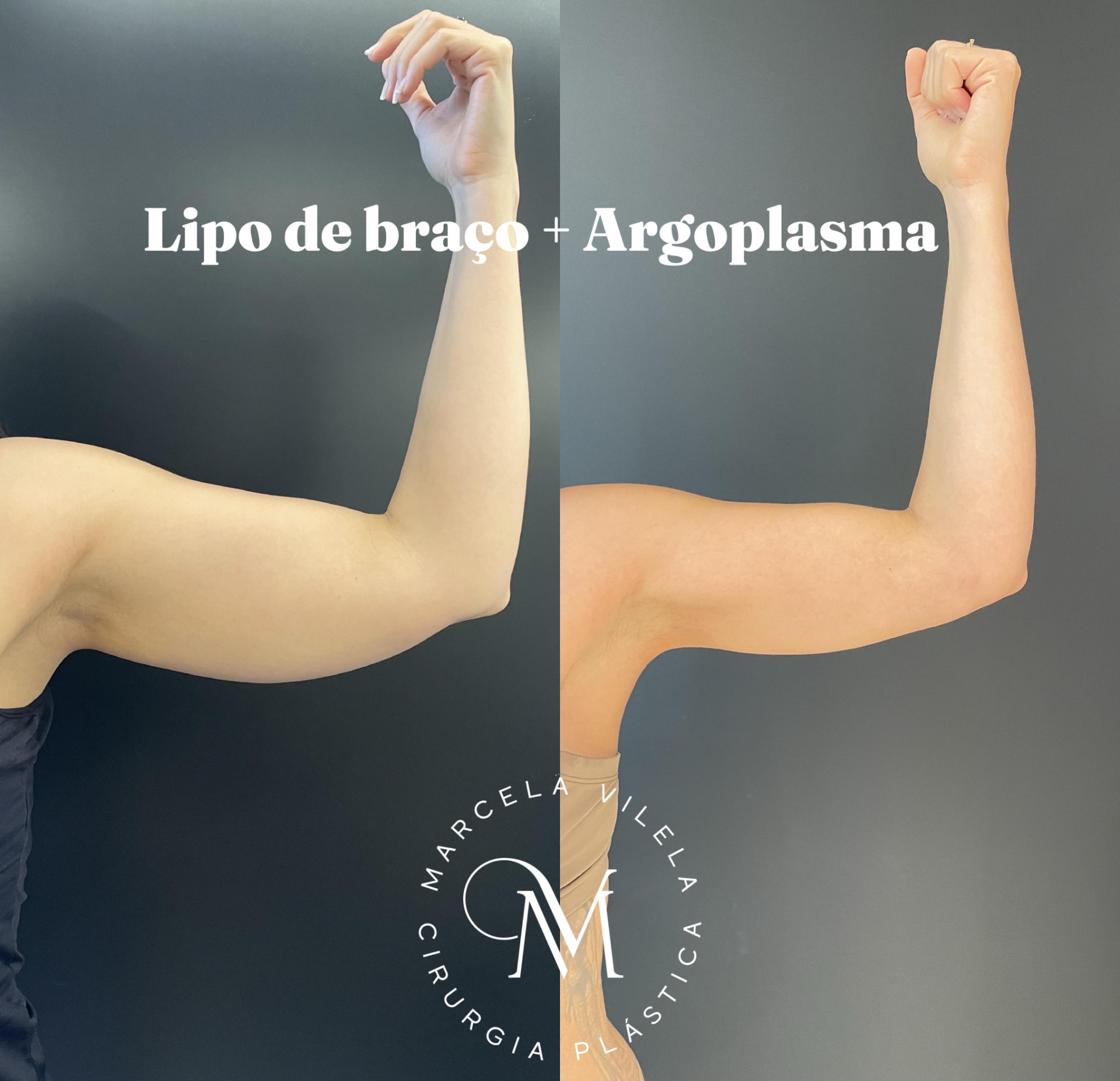 Antes e depois — Lipo de braço + Argoplasma: Braço mais definido com firmeza da pele