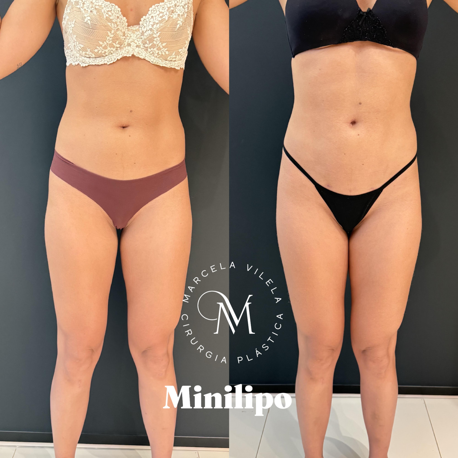 Antes e depois — Minilipo: Contorno de abdome e flancos