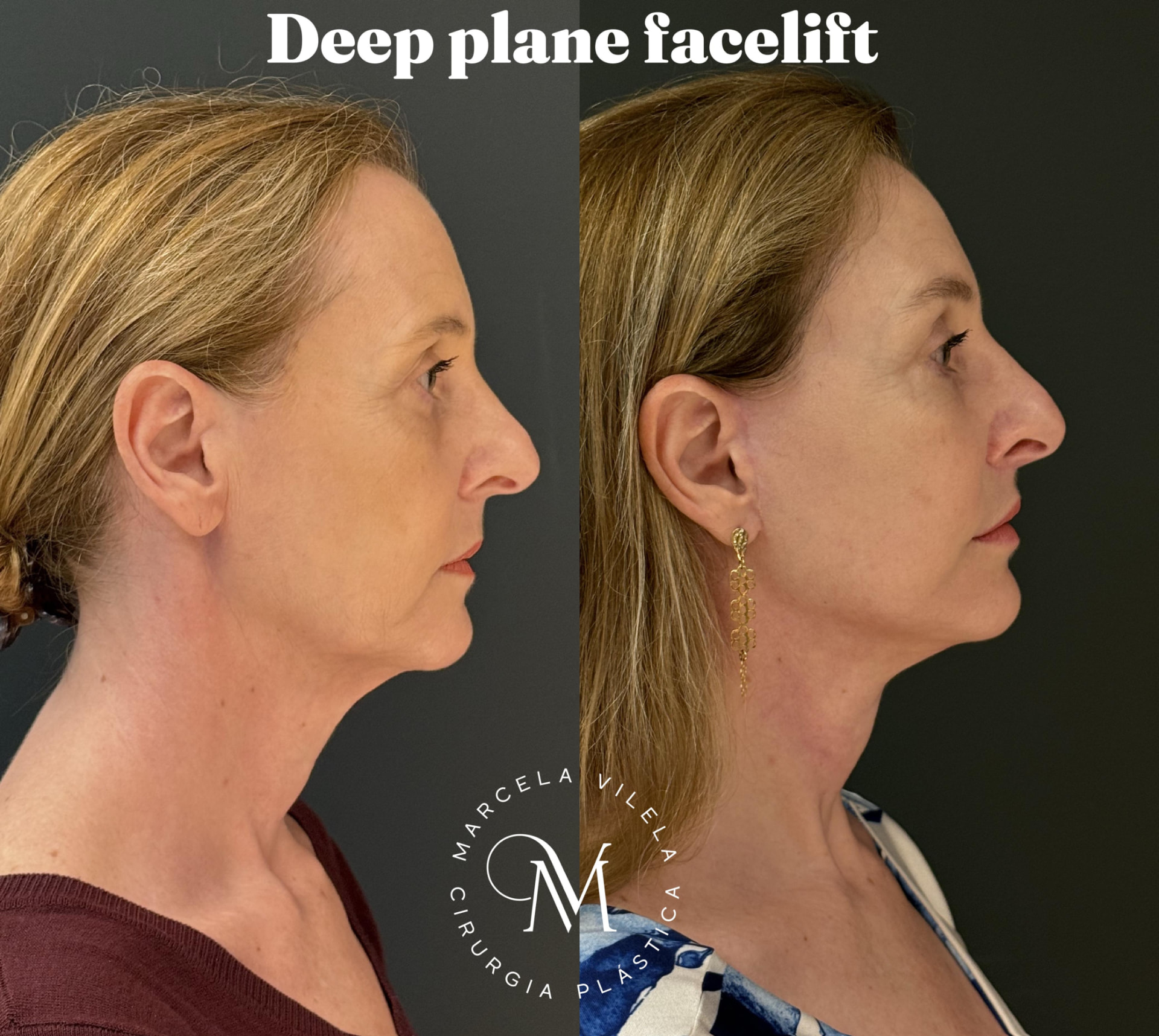 Antes e depois — Deep plane facelift: Rejuvenescimento facial e cervical natural