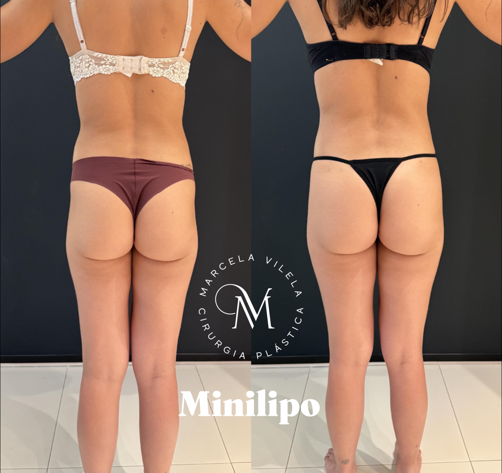 Antes e depois — Minilipo: Harmonia de dorso e glúteos